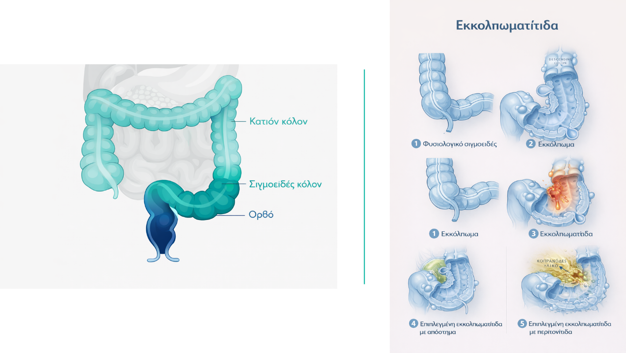 Εκκολπωματίτιδα